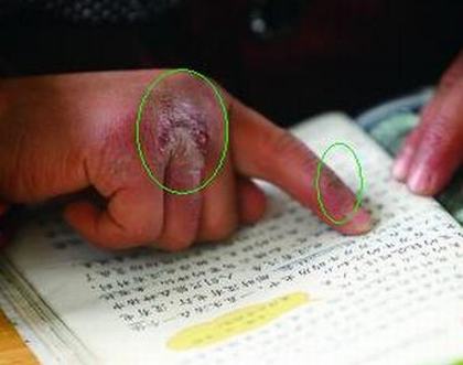【症状】盘点冻疮的症状