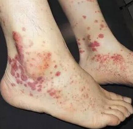 过敏性紫癜临床症状都有什么呢