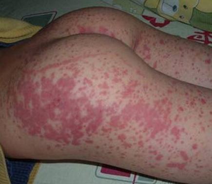 过敏性紫癜如何进行突发急救