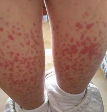 饮食治疗过敏性紫癜 