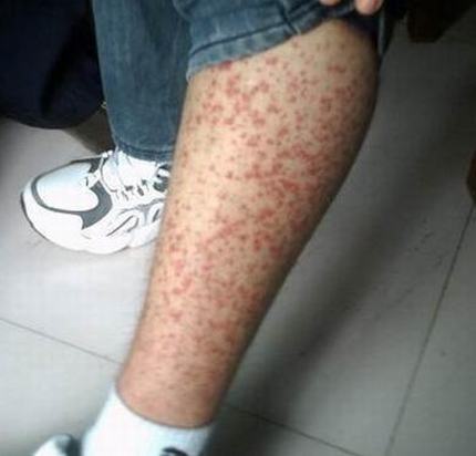 过敏性紫癜的腹部表现