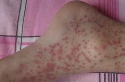 过敏性紫癜的护理措施有什么