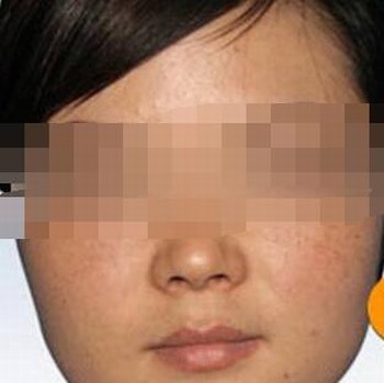 怎么诊断雀斑的症状