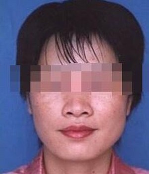怎样彻底除掉雀斑