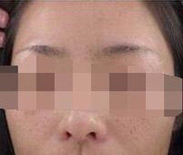 预防雀斑就要远离辐射