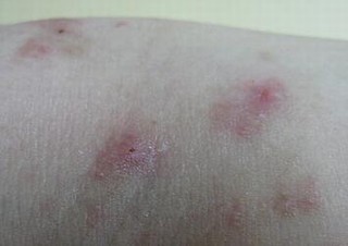 预防湿疹应怎样做起