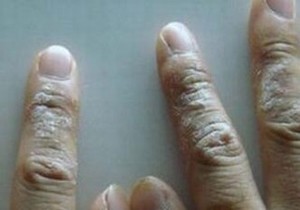 中医治疗婴儿湿疹