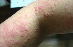 治疗湿疹用什么药好