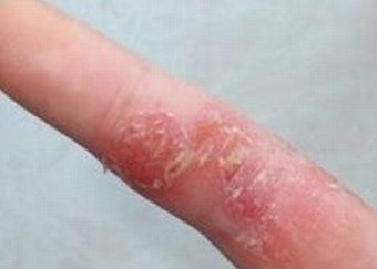 足癣的治疗难吗