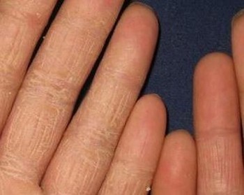 根治手足癣的措施