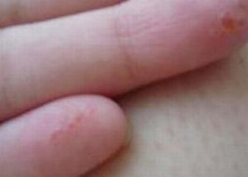 换季应该注重预防手足癣