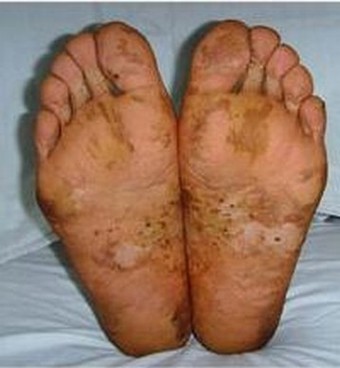 介绍脚癣患者的治疗的手法