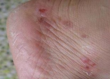 常见手足癣疾病的症状