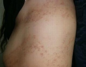 体癣的危害一般表现在那些方面