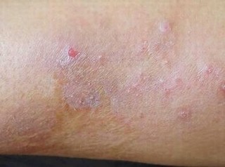 体癣发病后症状体现有什么