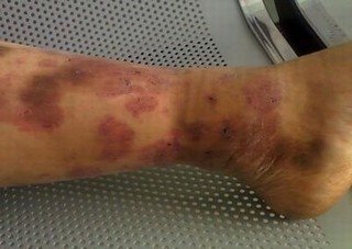 体癣该怎样彻底的进行治疗