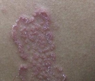 体癣患者如何更好的护理