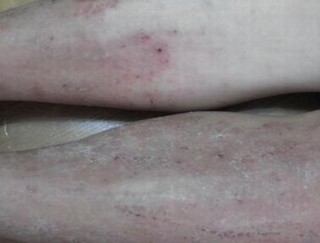 体癣会引起传染吗