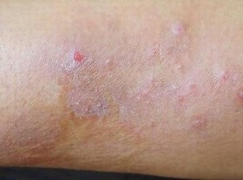 青岛体癣有哪些发病的症状