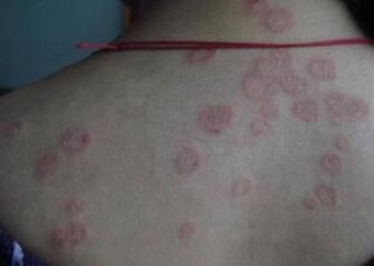 体癣的传染特点有哪些
