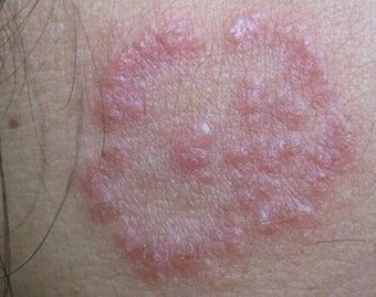 体癣的发病特点