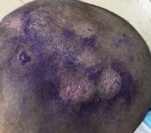 是宠物让儿童患上头癣