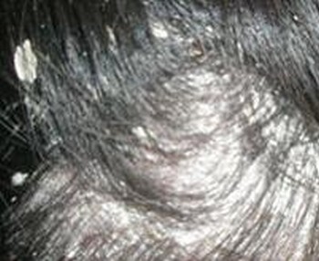 家长要小心孩子染上头癣