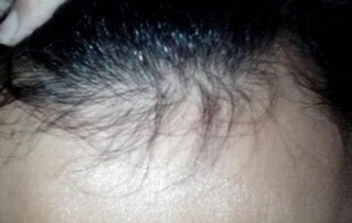 出现脱发的病因有什么你知道吗