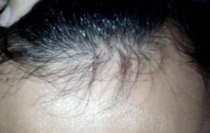 导致脱发的主要原因是什么