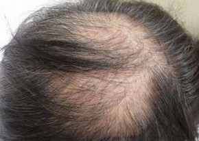 额头出现脂溢性脱发怎么办好
