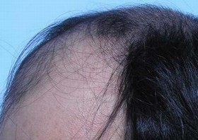 防止脱发比较好的措施