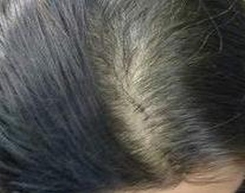 专家教你怎样的预防脱发