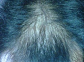 斑秃与脂溢性脱发的症状有什么不同