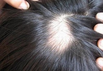 产后脱发怎样护理