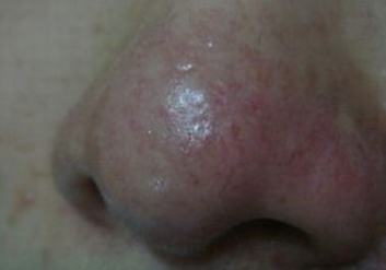 酒糟鼻的早期的症状表现为什么呢