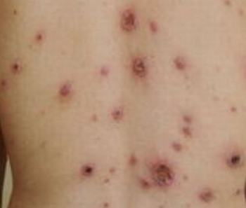 二期梅毒的皮肤损害有哪些 