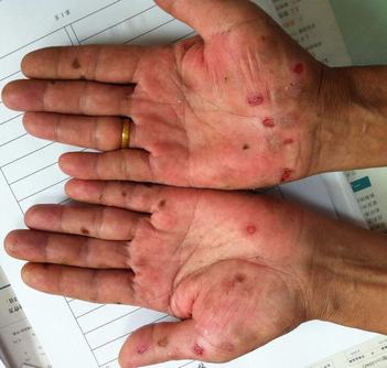 二期梅毒有哪些皮疹表现 