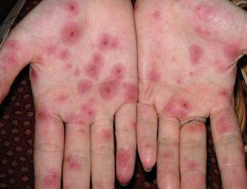 慢性梅毒症状图片有:慢性梅毒是由一期二期梅毒感染而出现的