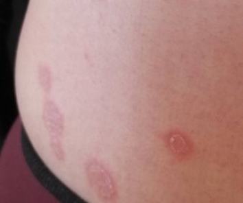 玫瑰糠疹的发病机制是什么 
