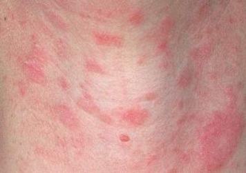 玫瑰糠疹的致病因素都是什么