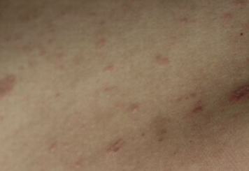 玫瑰糠疹的致病因素是哪些呢