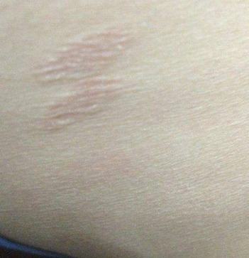 得玫瑰糠疹怎么引起的