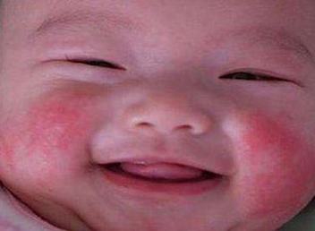 得了牛皮癣怎么办其发病特点是什么