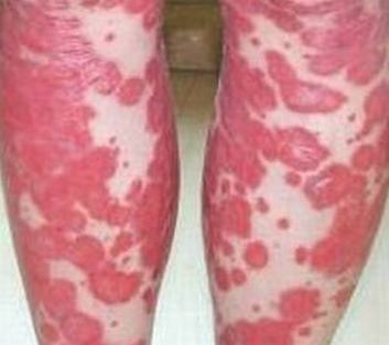 对于牛皮癣患者来说心理治疗、药物治疗同等重要