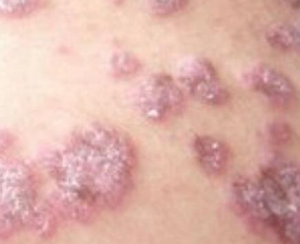红斑狼疮女性是否能怀孕吗