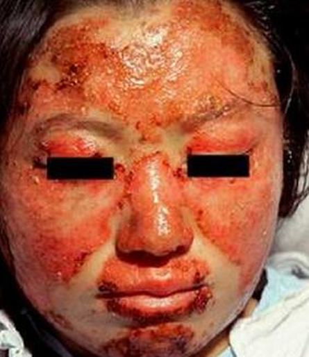 盘状红斑狼疮和本病的危害