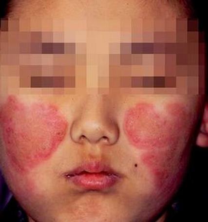 系统性红斑狼疮
