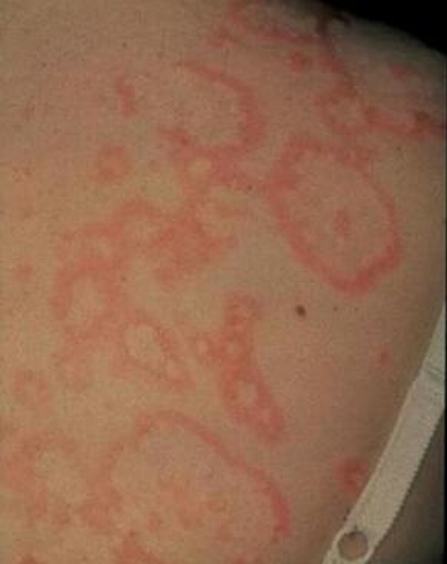 消掉鲜红斑痣有效行为