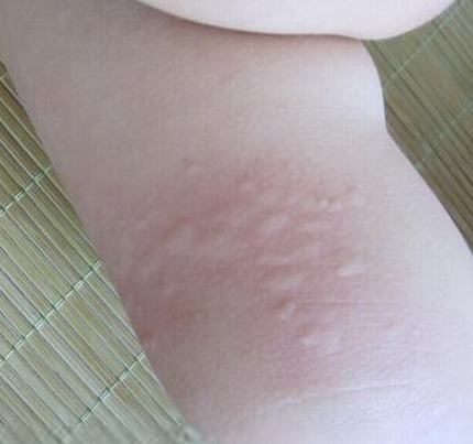 解析宝宝过敏性皮肤对策