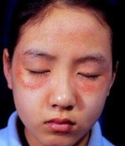 皮肌炎患者要积极预防